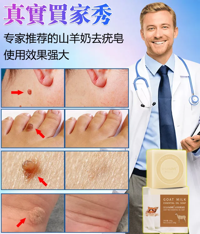 山羊奶去疣精油皂無需手術 衹需一洗輕鬆解决問題